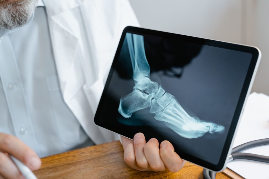 gout heel pain 2